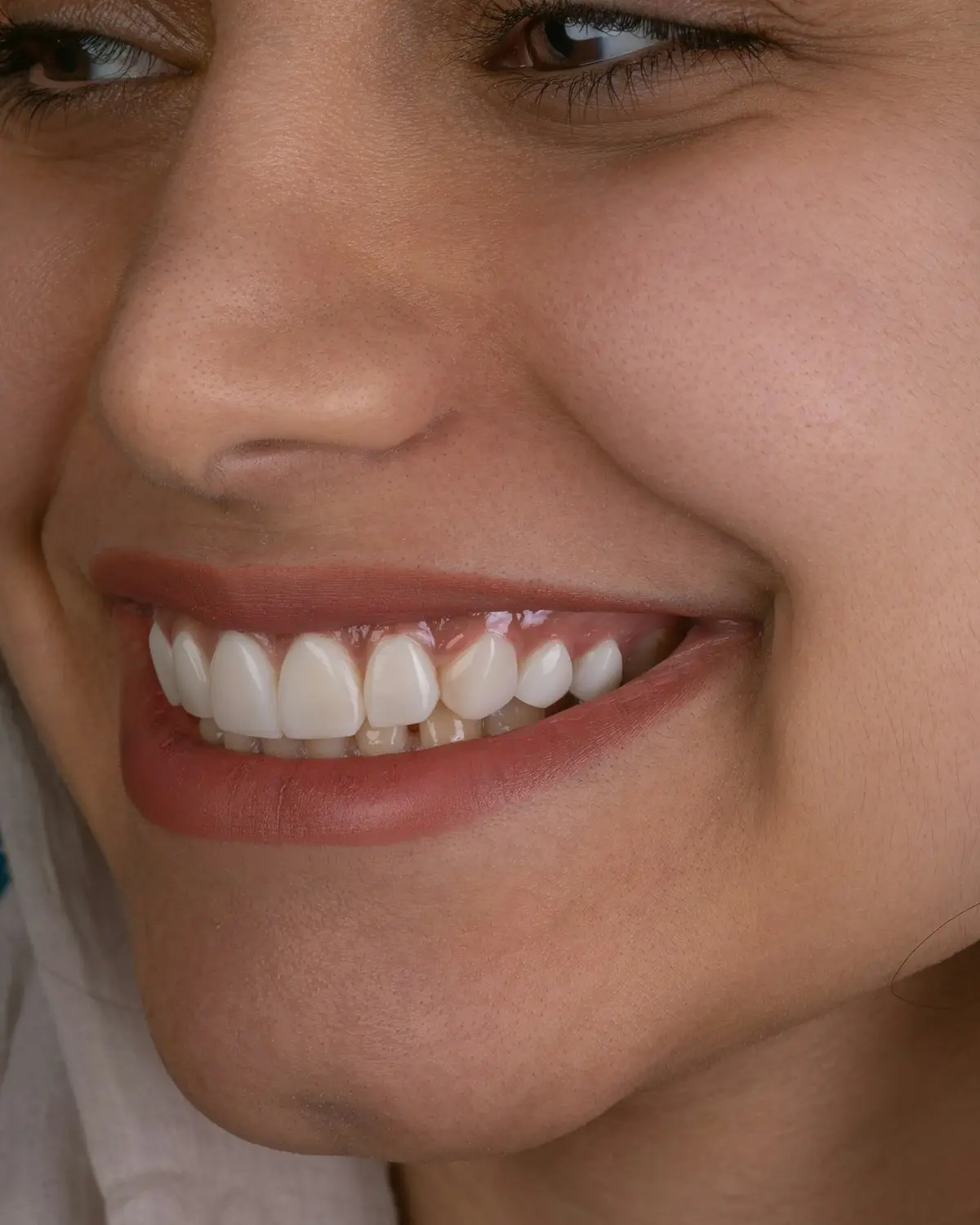Sourire après un traitement esthétique