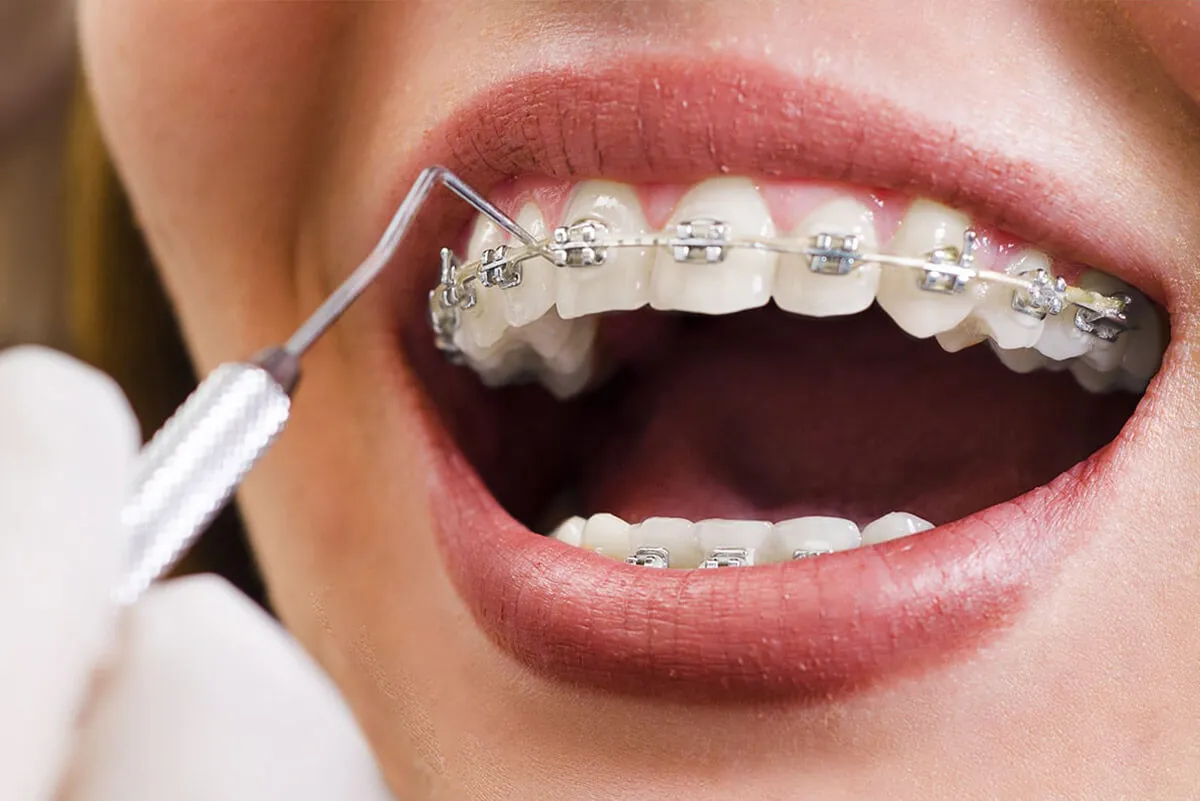 Why Invisalign is the Preferred Choice for Adults in Tangier